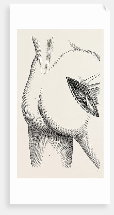 Excision of the hip by an external incision by Anonymous