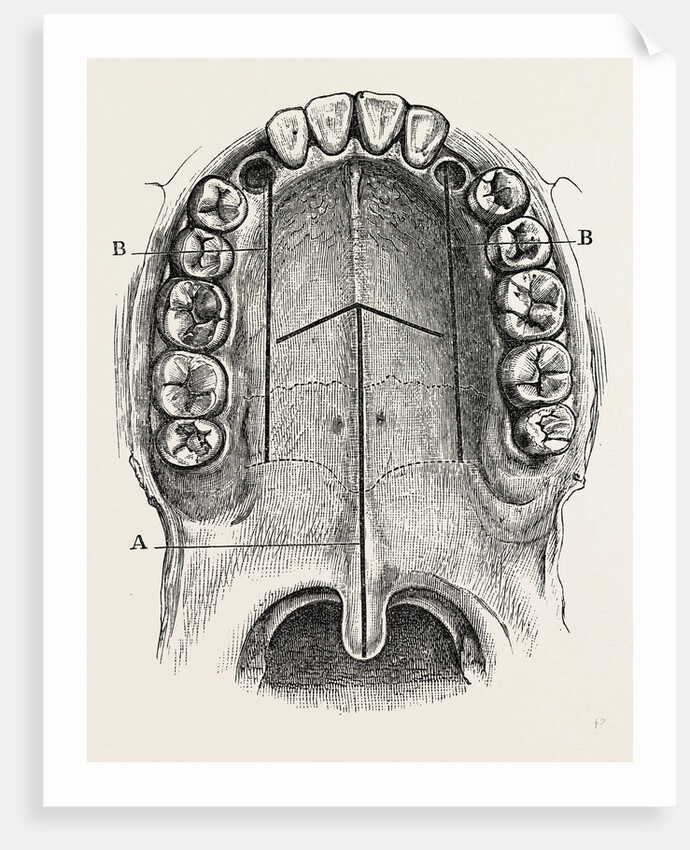 Nelaton's operation for nasal polypus by Anonymous