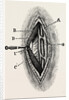 Ligatuite of the right radial by Anonymous