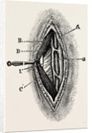 Ligatuite of the right radial by Anonymous