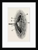 Ligatuite of the right radial by Anonymous