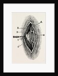 Ligatuite of the right radial by Anonymous