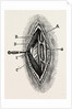 Ligatuite of the right radial by Anonymous