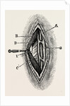 Ligatuite of the right radial by Anonymous