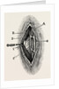 Ligatuite of the right radial by Anonymous