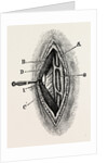 Ligatuite of the right radial by Anonymous