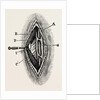 Ligatuite of the right radial by Anonymous