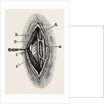 Ligatuite of the right radial by Anonymous