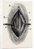 Ligature by Anonymous