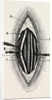 Ligature of the right finger by Anonymous