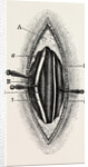 Ligature of the right finger by Anonymous
