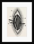 Ligature of the right finger by Anonymous
