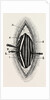 Ligature of the right finger by Anonymous
