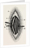 Ligature of the right finger by Anonymous