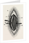 Ligature of the right finger by Anonymous
