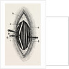 Ligature of the right finger by Anonymous