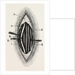 Ligature of the right finger by Anonymous