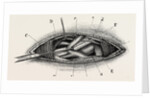 Ligature of the right subclavian ernird part by Anonymous