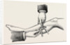 The mode of dividing the solidus muscle in ligature by Anonymous