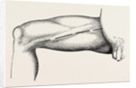 Ligature of the right common femoral at the base of scarpa's by Anonymous