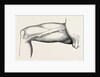Ligature of the right common femoral at the base of scarpa's by Anonymous