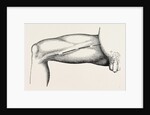 Ligature of the right common femoral at the base of scarpa's by Anonymous
