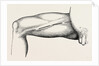 Ligature of the right common femoral at the base of scarpa's by Anonymous