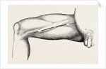 Ligature of the right common femoral at the base of scarpa's by Anonymous