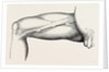 Ligature of the right common femoral at the base of scarpa's by Anonymous