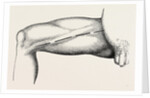 Ligature of the right common femoral at the base of scarpa's by Anonymous