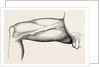 Ligature of the right common femoral at the base of scarpa's by Anonymous