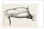 Ligature of the right common femoral at the base of scarpa's by Anonymous
