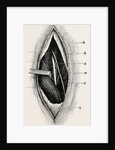 Ligature of by Anonymous