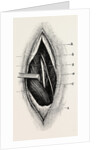 Ligature of by Anonymous