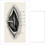 Ligature of by Anonymous