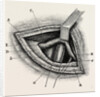 Ligature of right external iliac artery by Anonymous