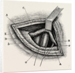 Ligature of right external iliac artery by Anonymous