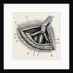 Ligature of right external iliac artery by Anonymous