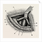 Ligature of right external iliac artery by Anonymous