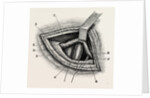 Ligature of right external iliac artery by Anonymous