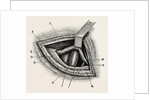 Ligature of right external iliac artery by Anonymous