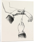 Circular amputation de la manchette by Anonymous