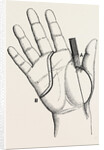 Disartieulation of the thumb by Anonymous