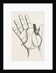 Disartieulation of the thumb by Anonymous