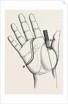 Disartieulation of the thumb by Anonymous