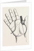 Disartieulation of the thumb by Anonymous