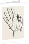 Disartieulation of the thumb by Anonymous