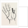 Disartieulation of the thumb by Anonymous