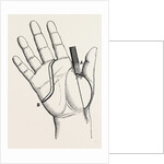 Disartieulation of the thumb by Anonymous
