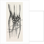 Disarticulation by Anonymous